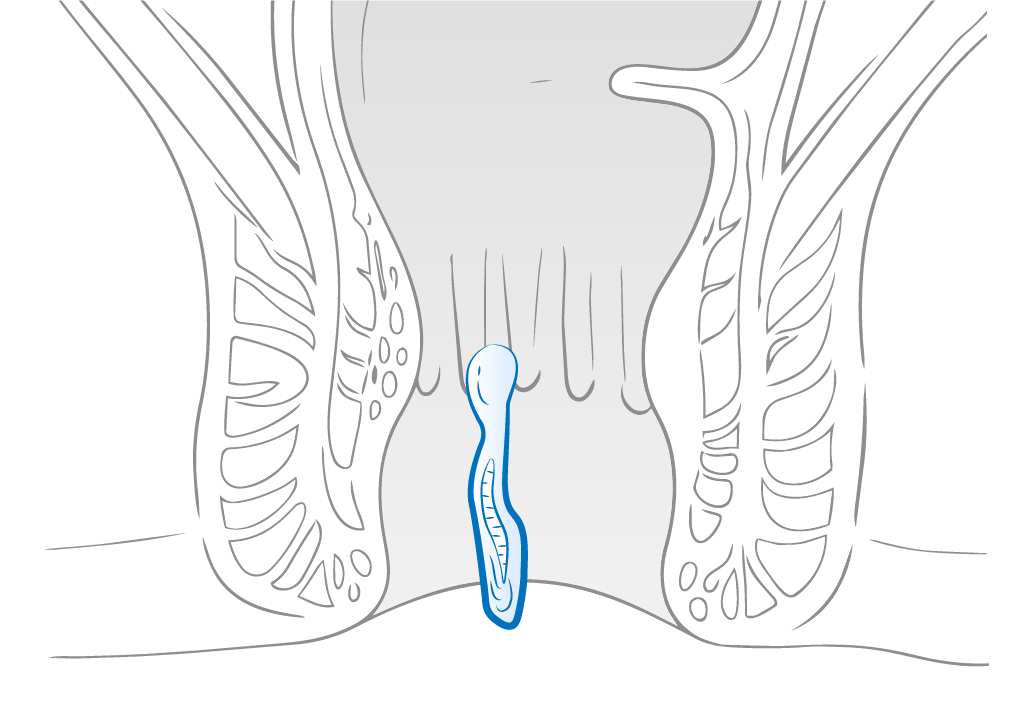 Anal fissure anatomy illustration