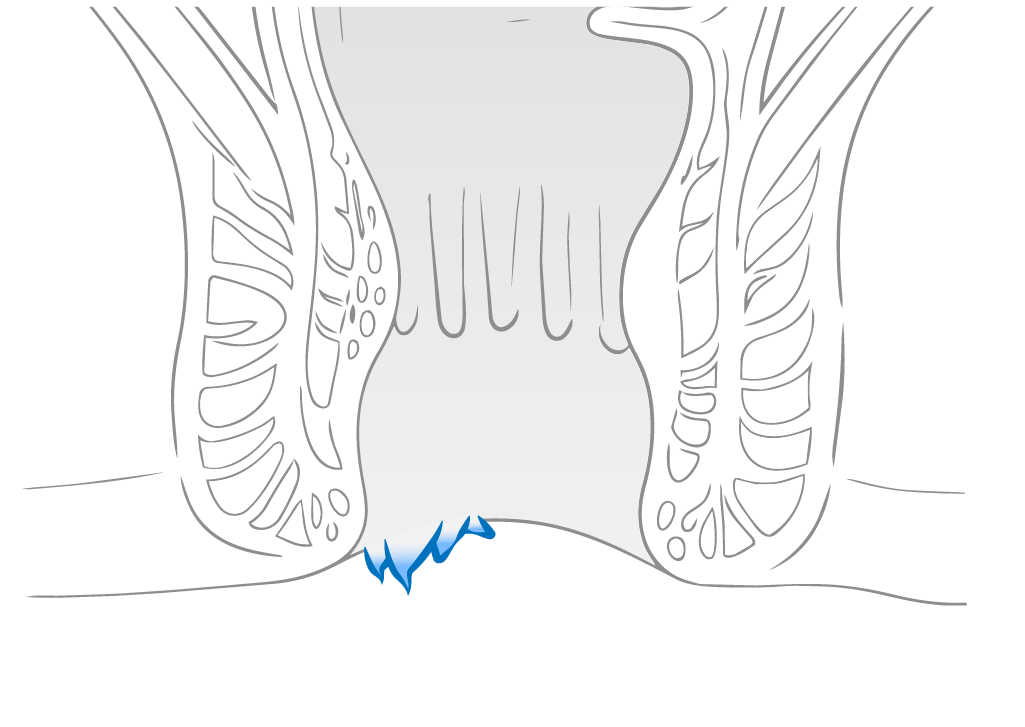 Anal skin tag illustration