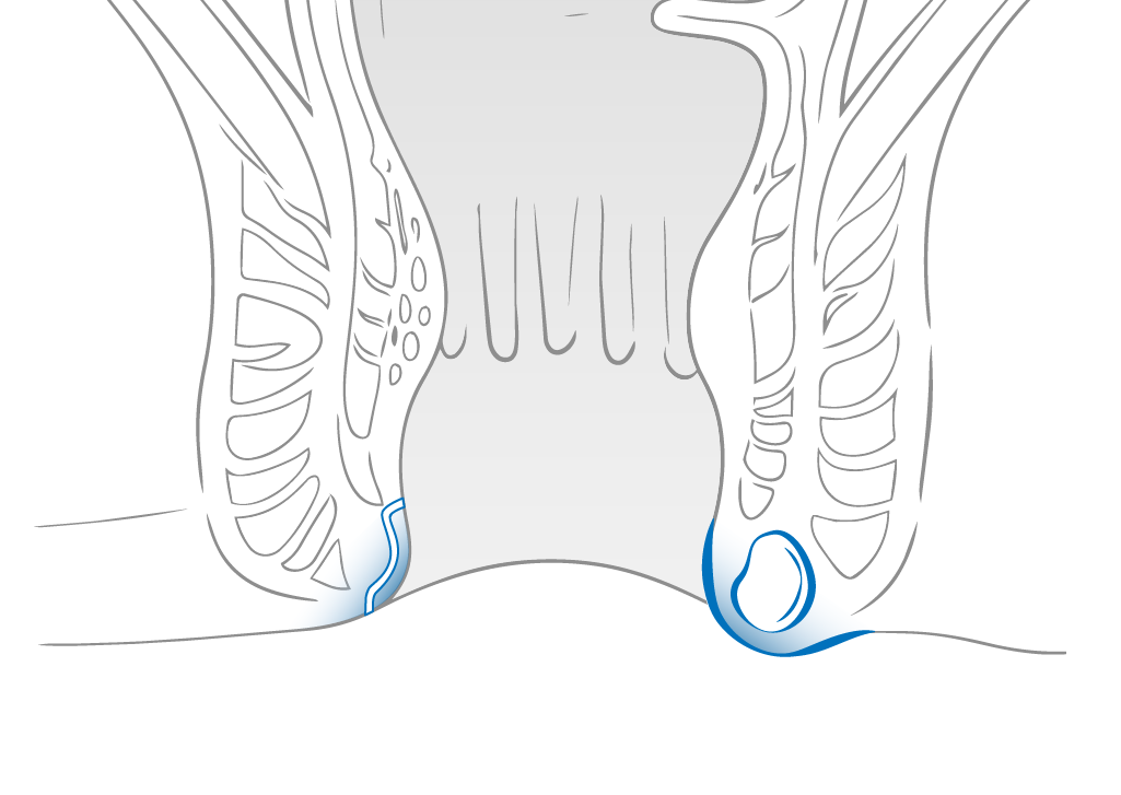 Perianal abscess and anal fistula illustration